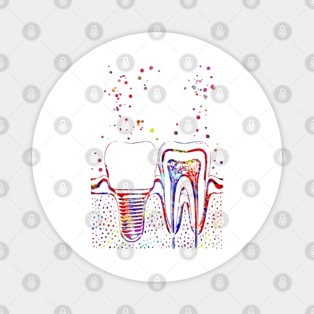 Human teeth and dental implant, Magnet by RosaliArt